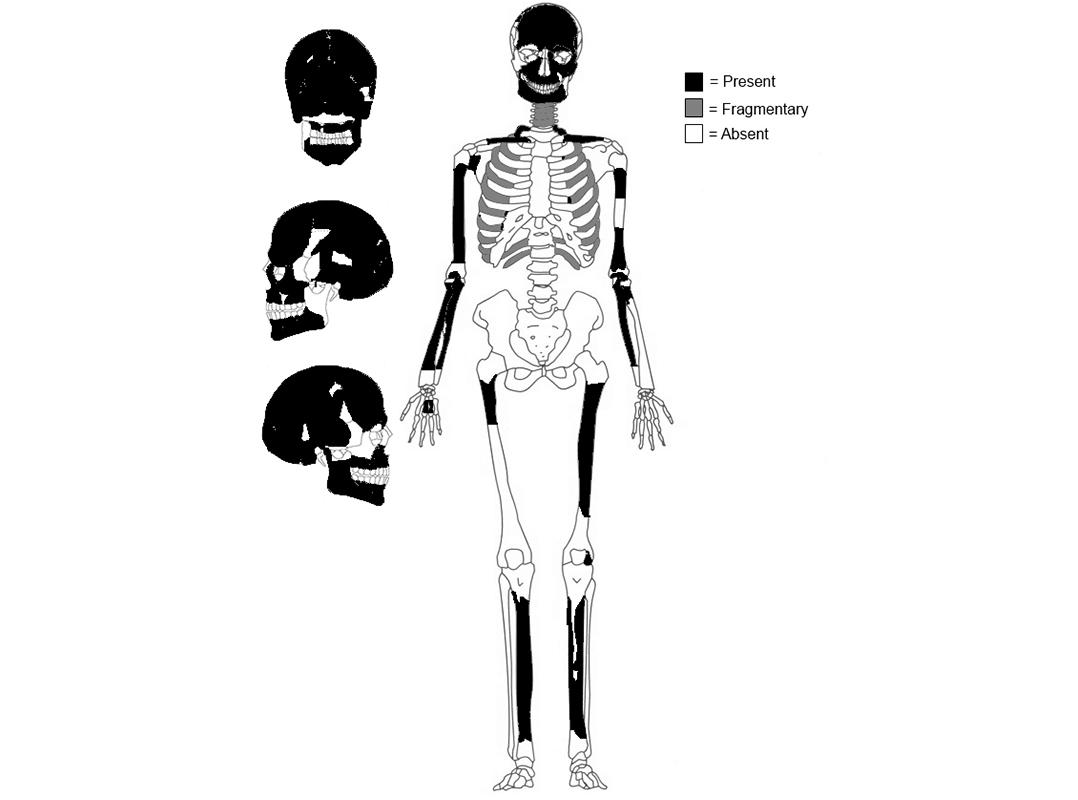 Bones of teen