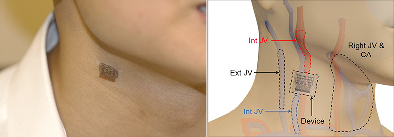 blood-pressure-patch-on-neck.jpg